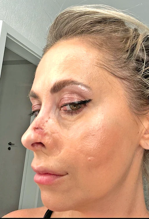 A suferit  mai multe  operații  la nas