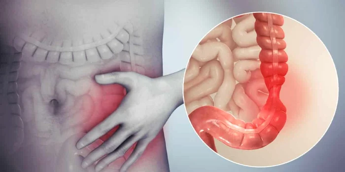 Colonul iritabil este o afecţiune de care suferă tot mai multe persoane Foto: SJU Târgu Jiu