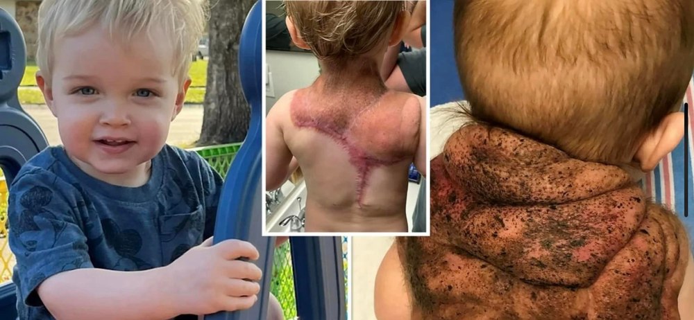 Băiețelul care s-a născut cu o „carapace“ pe spate i-a uimit pe medici. Despre ce boală rară este vorba FOTO