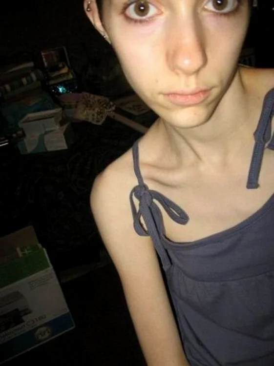 Anorexicele sunt sexy?