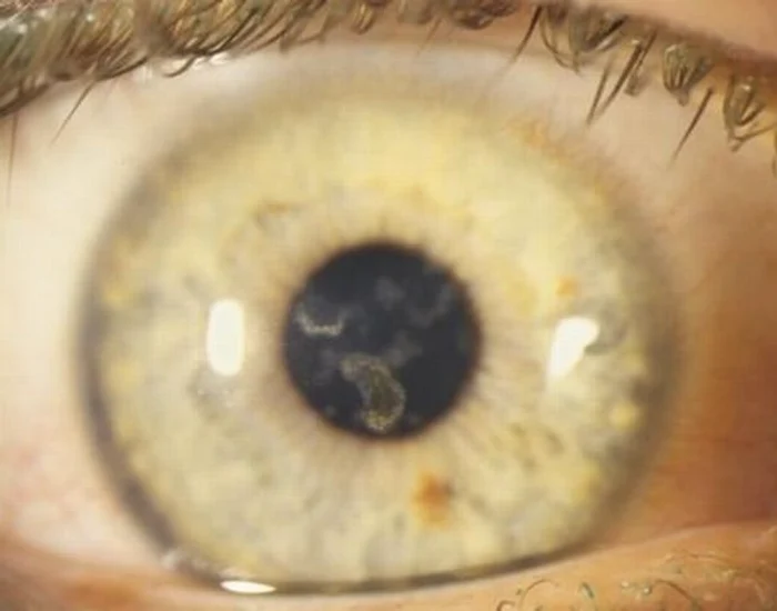 Aşa arată ochiul după ce porţi lentila zilnică timp de o lună
