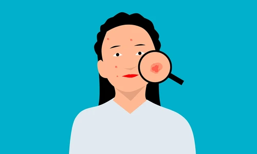 Acnee in diverse locuri pe corp  Sursa foto Pixabay png