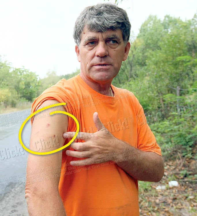 Bărbatul ne-a arătat urmele lăsate de ghearele ursului pe corpul său (Fotografii: Dorin Constanda)