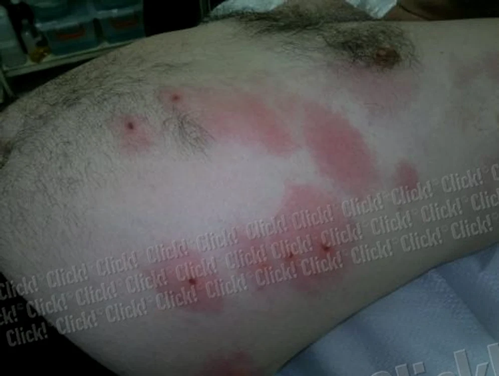 
    Căpuşele "l-au atacat" pe ieşean la nivelul abdomenului. (Foto Adevărul)  