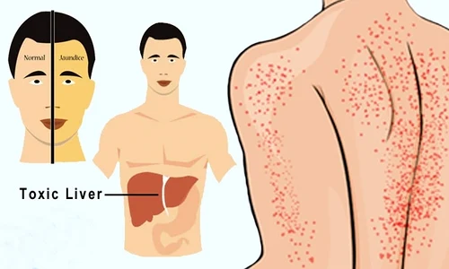 1 12 simptome ale unui ficat deteriorat fii foarte atenta la ele sxxz jpg jpeg