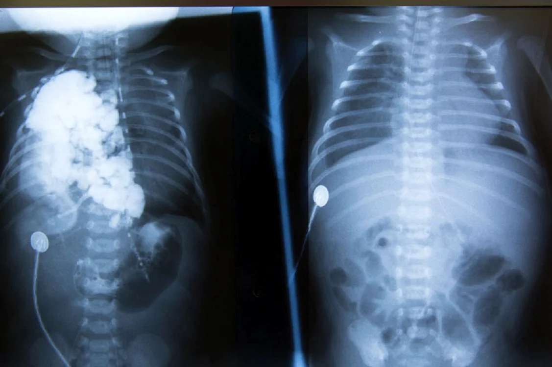 Cutia toracică a bebeluşului, înainte şi după operaţia care a durat două ore