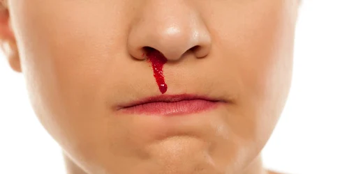 Sângerare nazală. FOTO drdenissecretu.ro