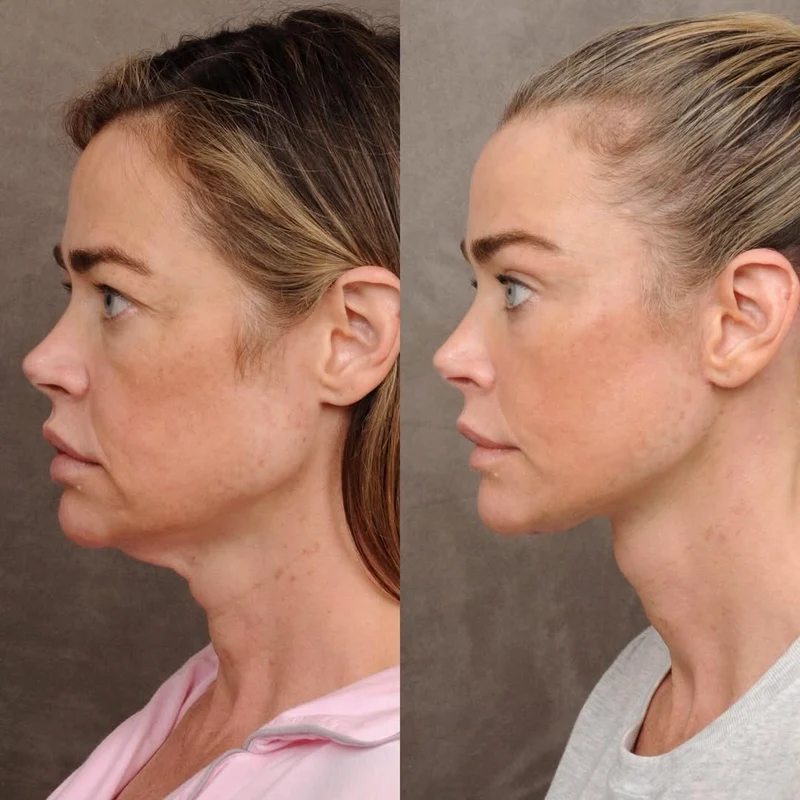 Denise Richards lifting, Foto Instagram 