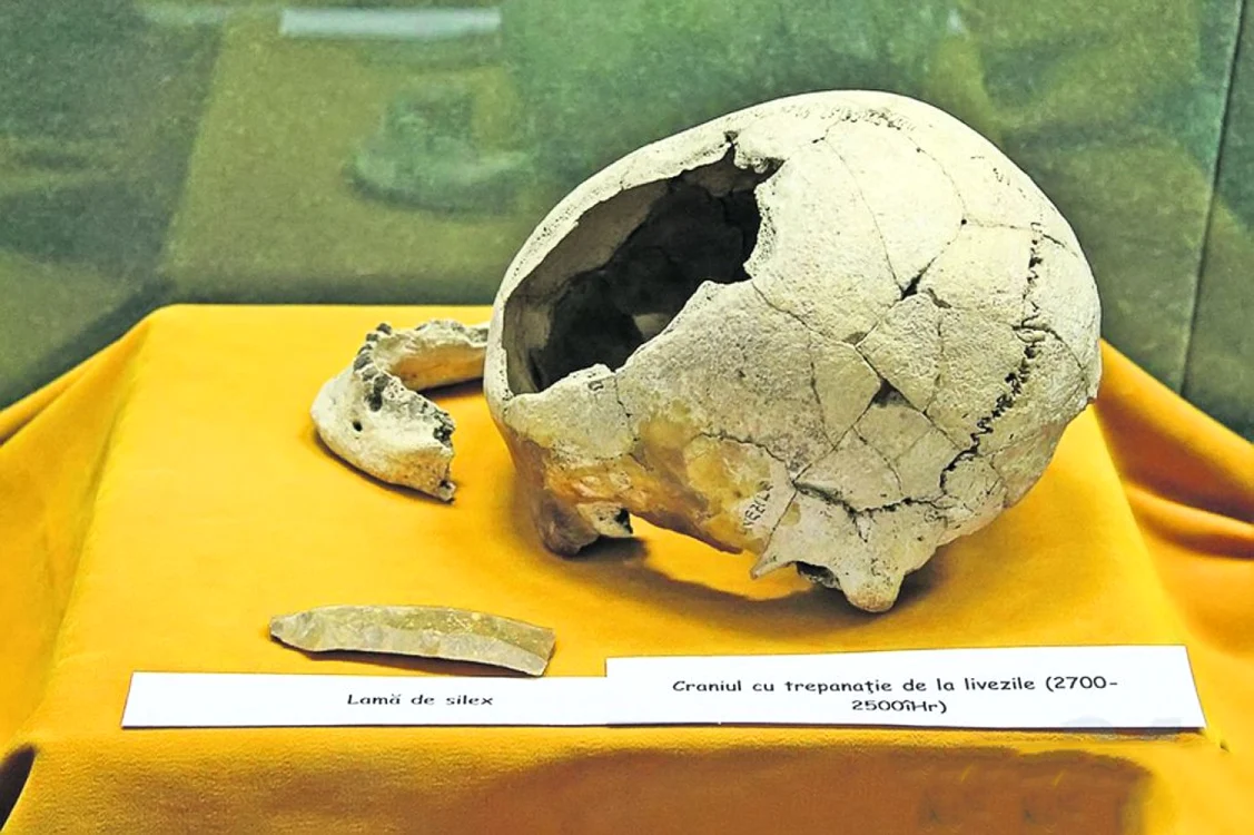 Craniul descoperit la Lvezile şi operaţia realizată în urmă cu 4500 de ani
