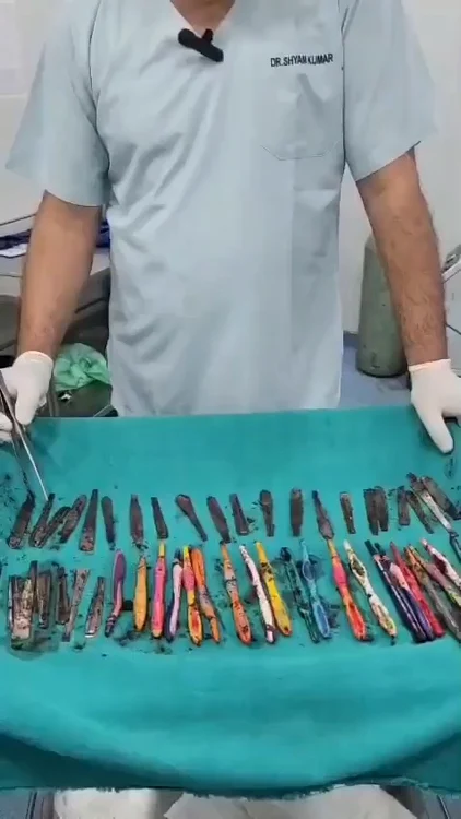 Medicii au scos din stomacul lui 29 de lingurițe, 19 periuțe de dinți și două pixuri