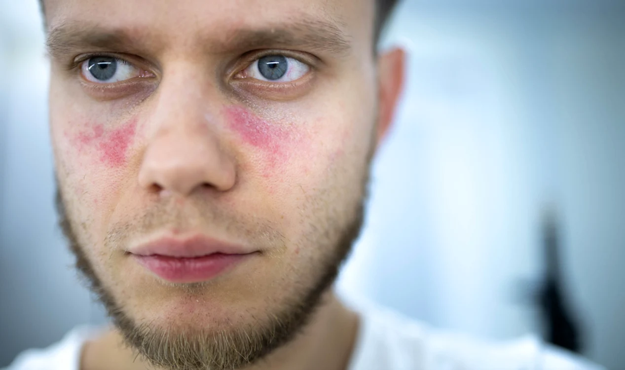 1 lupus jpg jpeg