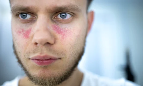 1 lupus jpg jpeg
