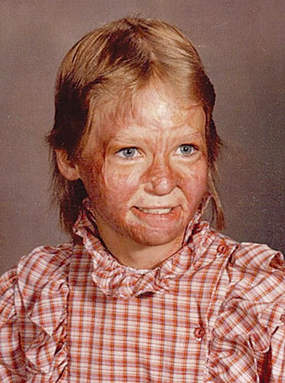 A suferit arsuri când era copil. SURSĂ FOTO: PROFIMEDIA