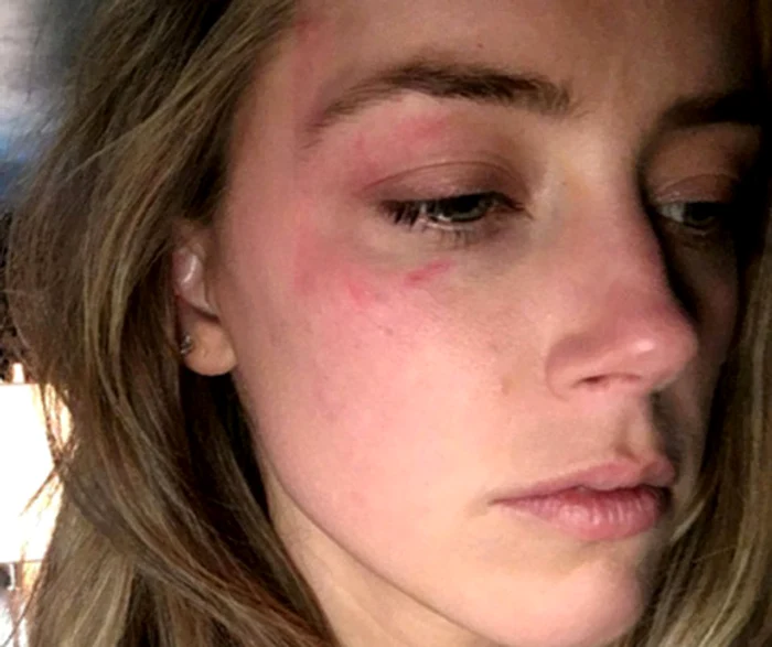 Amber a prezentat o serie de fotografii în care se văd clar urmele bătăii încasate de la Depp