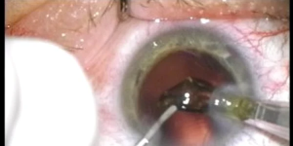 cataracta
