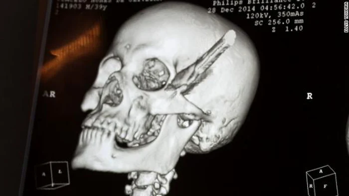 CNN a relatat cazul bărbatului brazilianFoto CNN