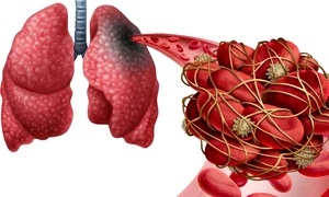 cheaguri sange embolism pulmonar jpeg