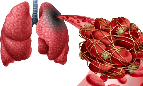 cheaguri sange embolism pulmonar jpeg