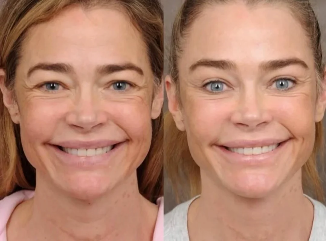 Actrița americană Denise Richards imagini inainte si dupa lifting facial FOTO: Instagram