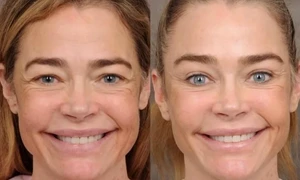 Actrița americană Denise Richards imagini inainte si dupa lifting facial FOTO: Instagram