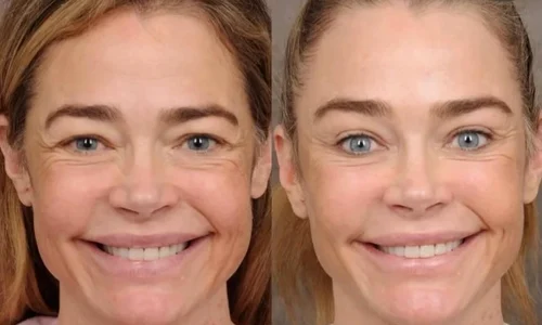 Actrița americană Denise Richards imagini inainte si dupa lifting facial FOTO: Instagram