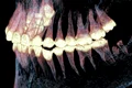 mandibula operata 2500 ani jpg