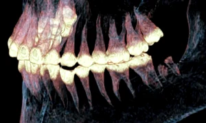 mandibula operata 2500 ani jpg