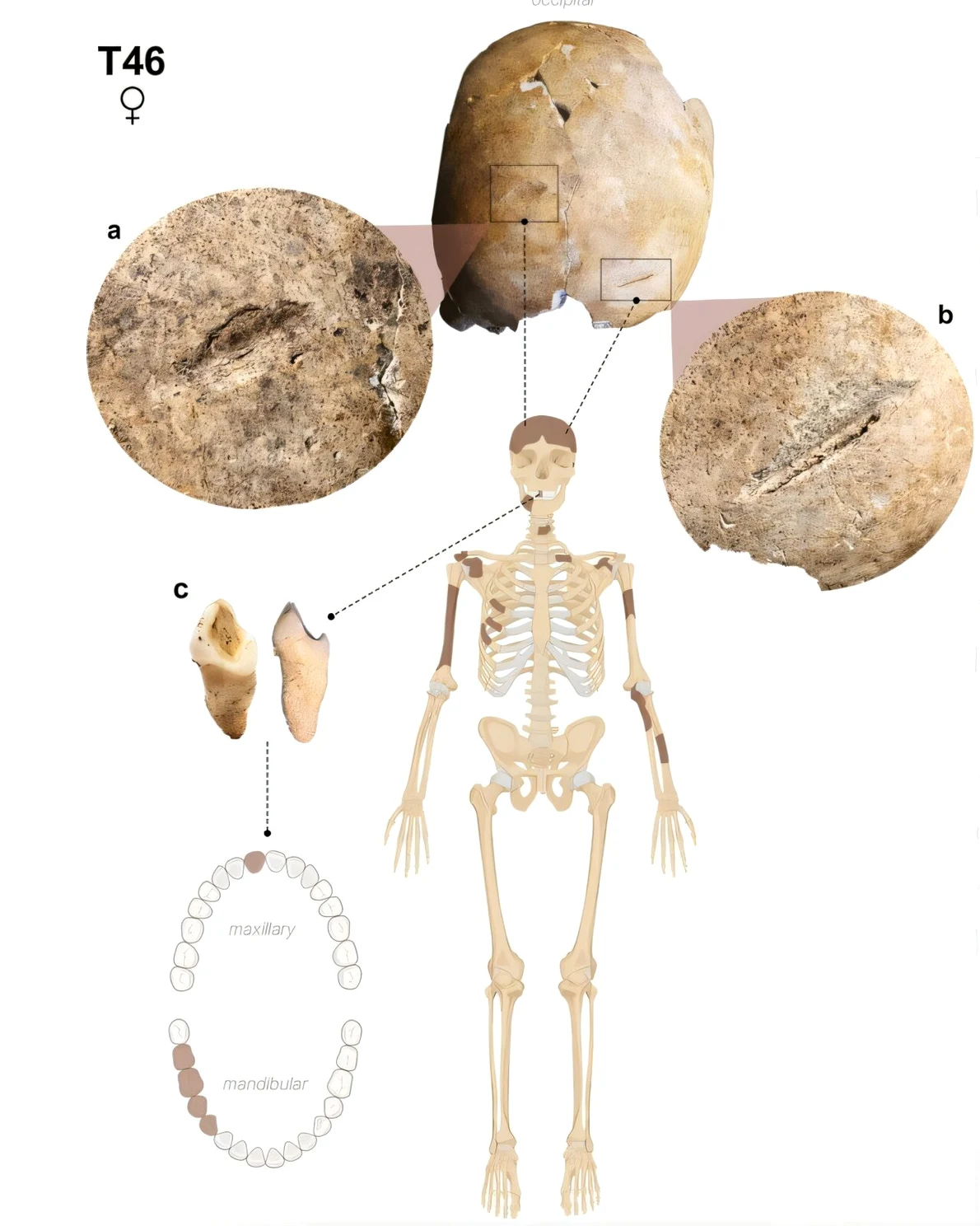 Scheletul T46 prezintă răni la nivelul craniului și uzură neobișnuită a dinților. Zonele întunecate reprezintă oasele care au fost recuperate de arheologi (© International Journal of Paleopathology (2026). DOI: 10.1016/j.ijpp.2026.04.008)