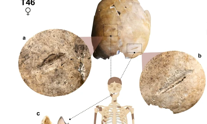 Scheletul T46 prezintă răni la nivelul craniului și uzură neobișnuită a dinților. Zonele întunecate reprezintă oasele care au fost recuperate de arheologi (© International Journal of Paleopathology (2026). DOI: 10.1016/j.ijpp.2026.04.008)