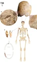 Scheletul T46 prezintă răni la nivelul craniului și uzură neobișnuită a dinților. Zonele întunecate reprezintă oasele care au fost recuperate de arheologi (© International Journal of Paleopathology (2026). DOI: 10.1016/j.ijpp.2026.04.008)