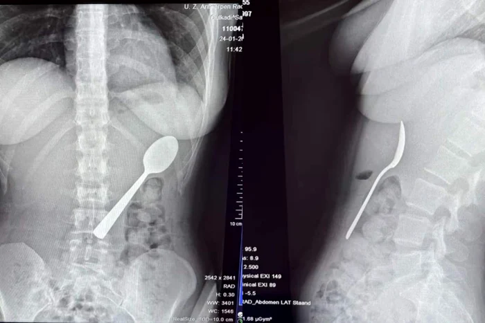 O femeie din Belgia a înghițit o lingură FOTO: Jam Press