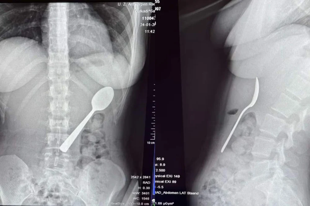 O tânără a înghițit o lingură de 17 cm din cauza câinelui: „Fie înghițeam, fie mă sufocam”