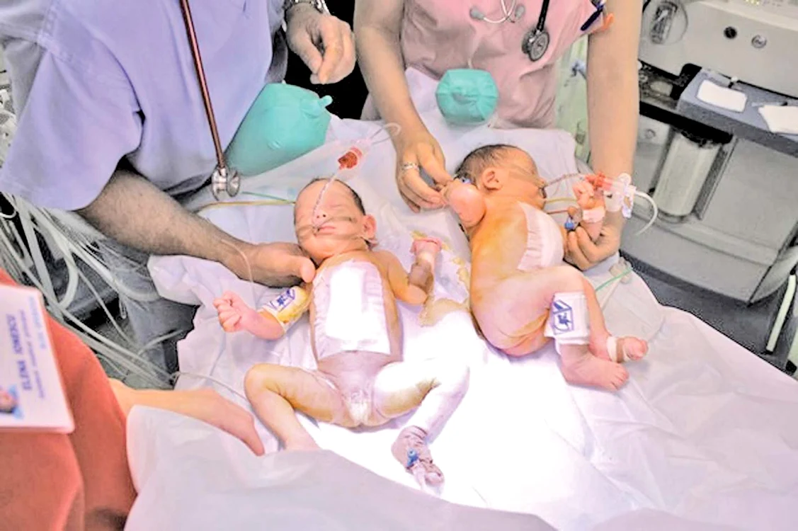 
    Elena Maia şi Maria Sarah, încă intubate, imediat după finalizarea operaţieiFoto: Spitalul “Marie Curie”  