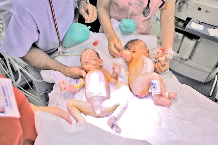 
    Elena Maia şi Maria Sarah, încă intubate, imediat după finalizarea operaţieiFoto: Spitalul “Marie Curie”  