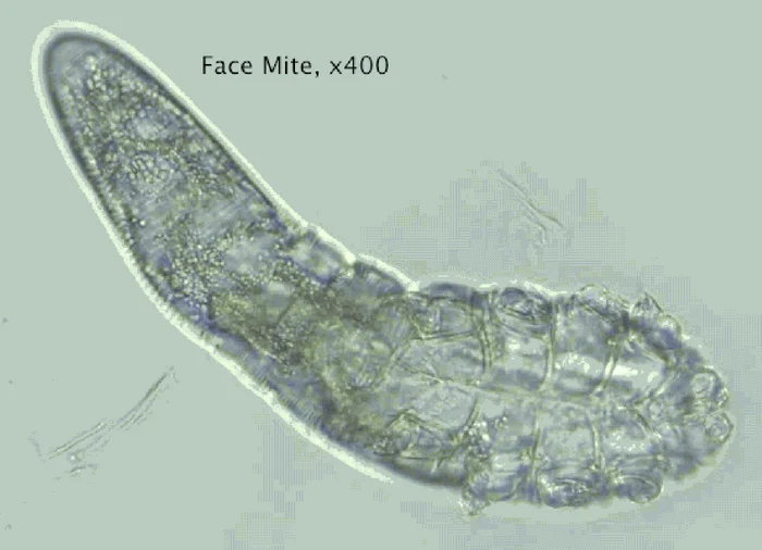 capusa demodex