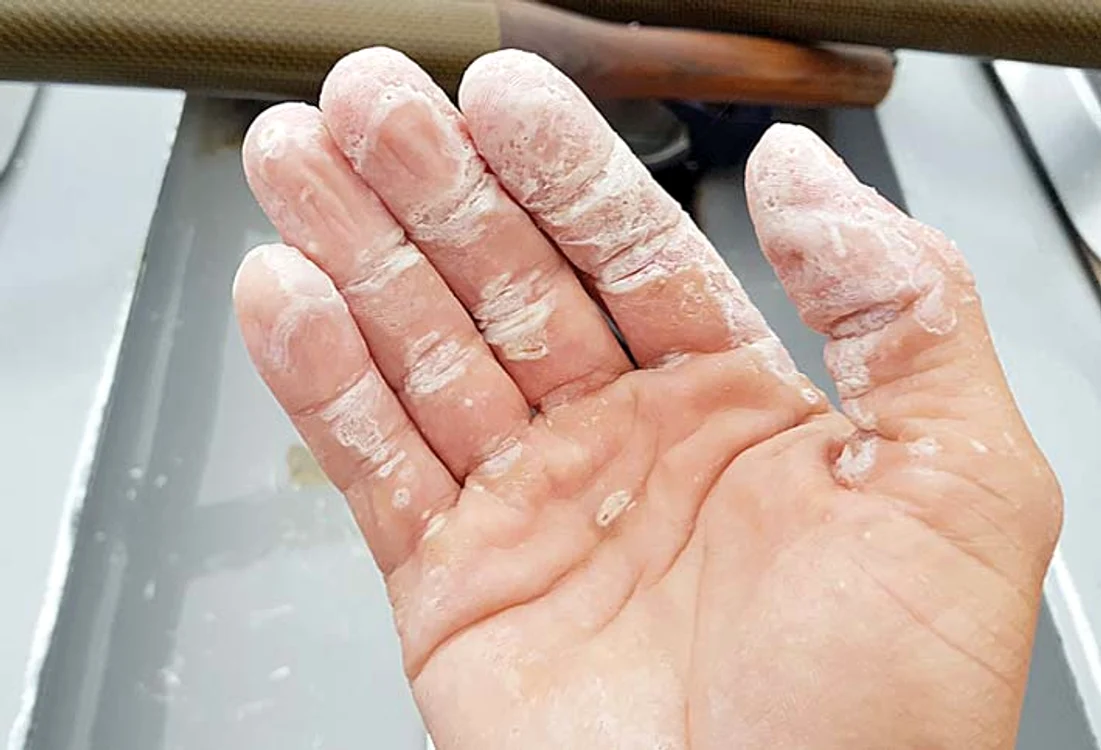 Aşa arătau palmele sale după ce a vâslit 38 de zile 