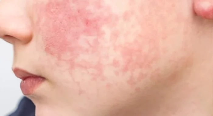 Boala este des confundată cu o răceală