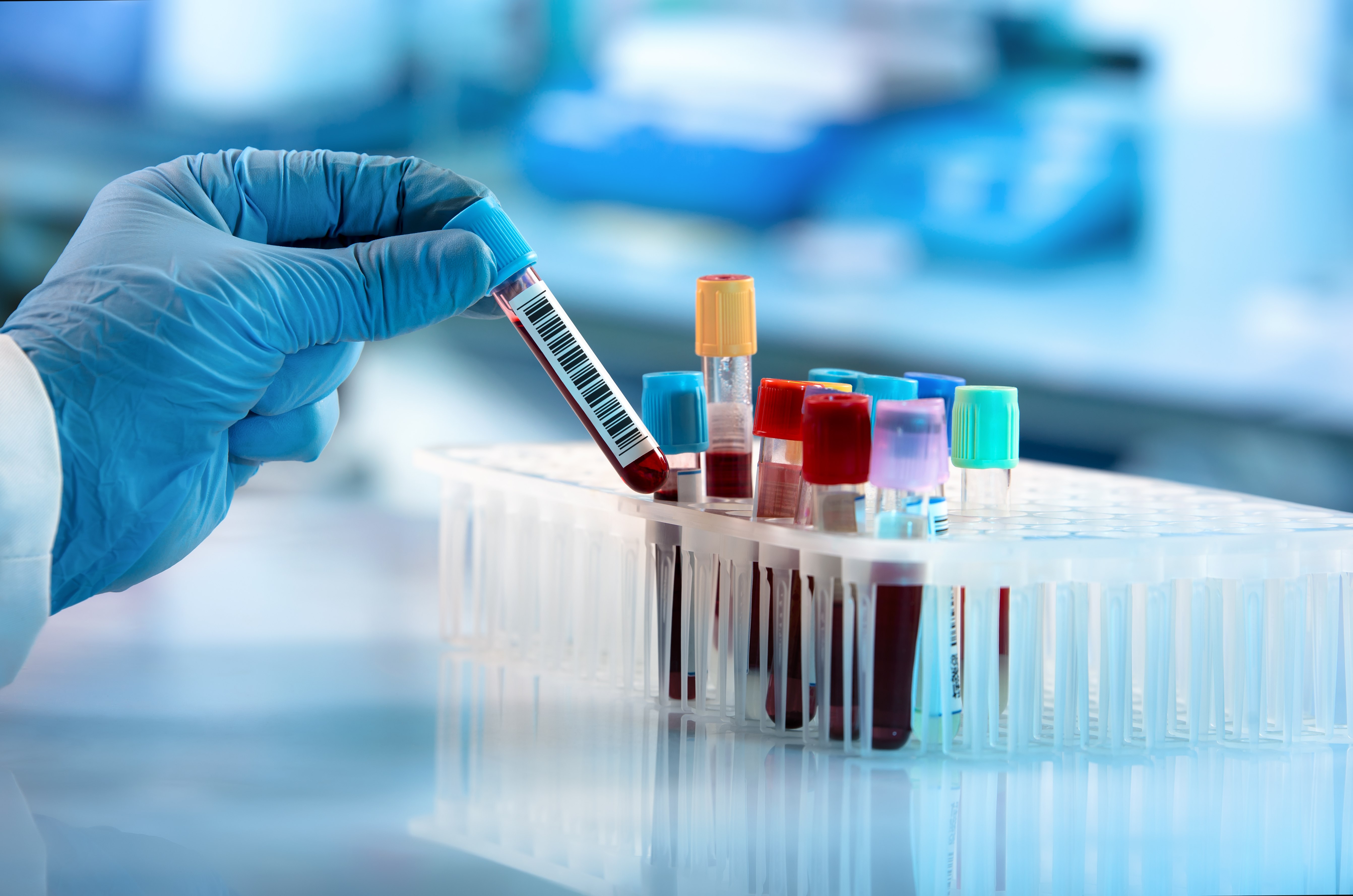 Testul obișnuit care detectează peste 50 de tipuri de cancer și prezice cu precizie locația bolnavă în corp. Testul obișnuit care detectează peste 50 de tipuri de cancer și prezice cu precizie locația bolnavă în corp.