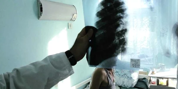 tuberculoza-foto viata medicala
