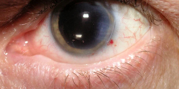 cataracta