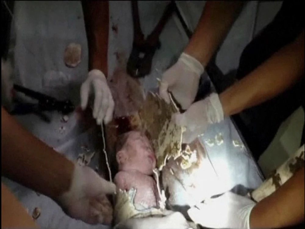 
    Copilul a fost salvat de medici  