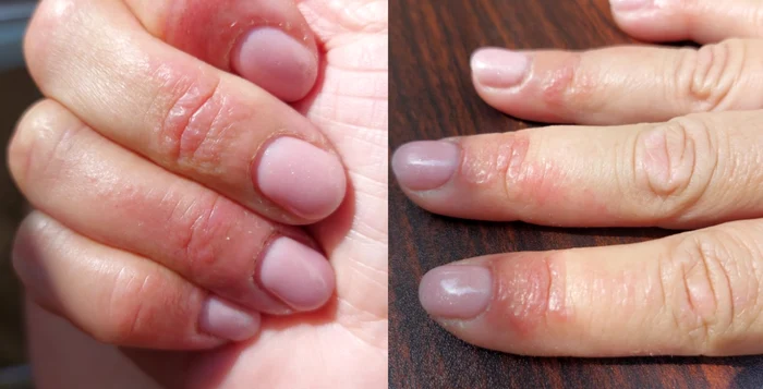 Iată ce a pățit o cititoare după ce și-a făcut manichiura cu ojă semipermanentă / FOTO: Click!