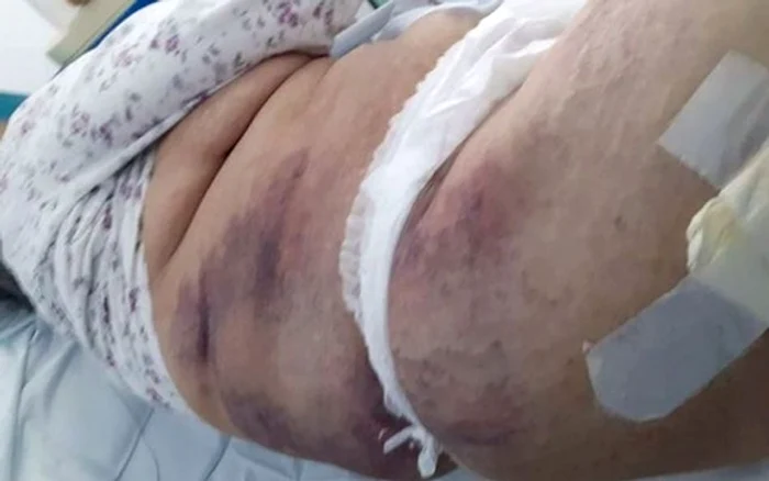 
    Pacienta a fost găsită cu multiple vânătăi pe corp și un picior ruptFoto: gorjonline.ro    
