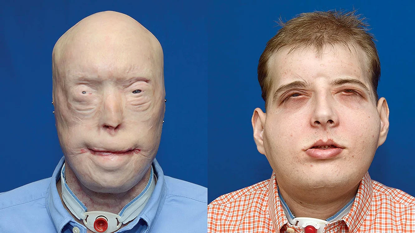 Pompierului Patrick Hardison, de 41 de ani, i s-a făcut cel mai extins transplant de faţă din lume