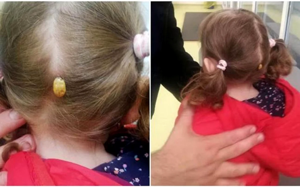 O fetiţă a ajuns la spital cu o căpuşă uriaşă pe cap, după ce s-a jucat într-un parc FOTO: stirisuceava.net