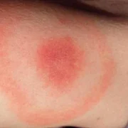 Persoanele cu această grupă sanguină sunt predispuse la muşcăturile de căpuşe