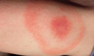 Persoanele cu această grupă sanguină sunt predispuse la muşcăturile de căpuşe