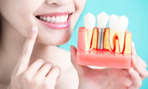 1 clicksanatate implantologiesector4 jpg jpeg