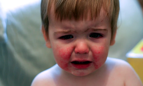 Boala obrajilor pălmuiţi revine  Cum se manifestă cea de a cincea boală a copilăriei jpeg