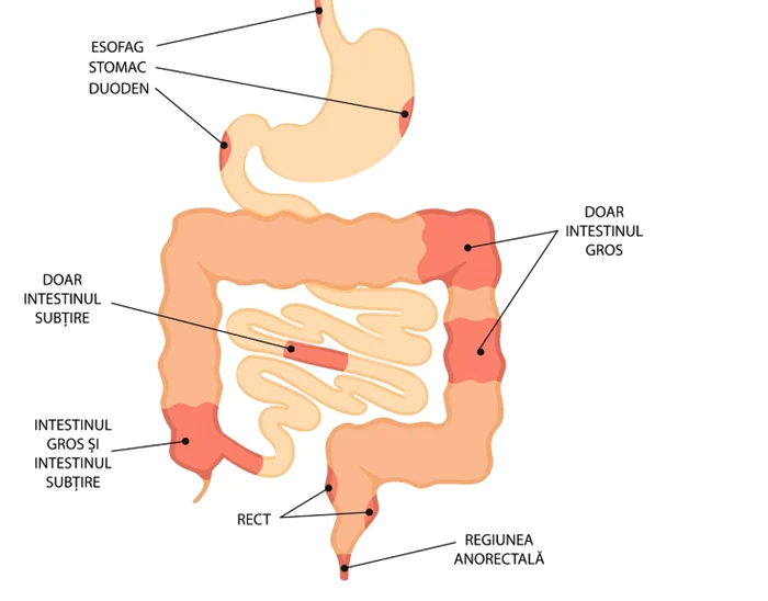 crohn